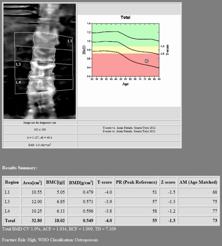 1st DXA Scan (Before Romosozumab treatment)