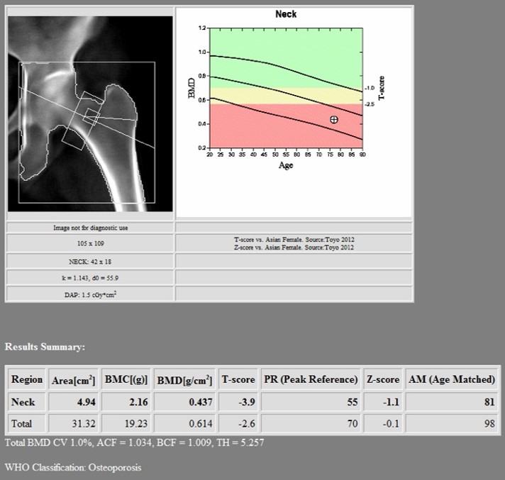 1st DXA Scan (Before Romosozumab treatment)