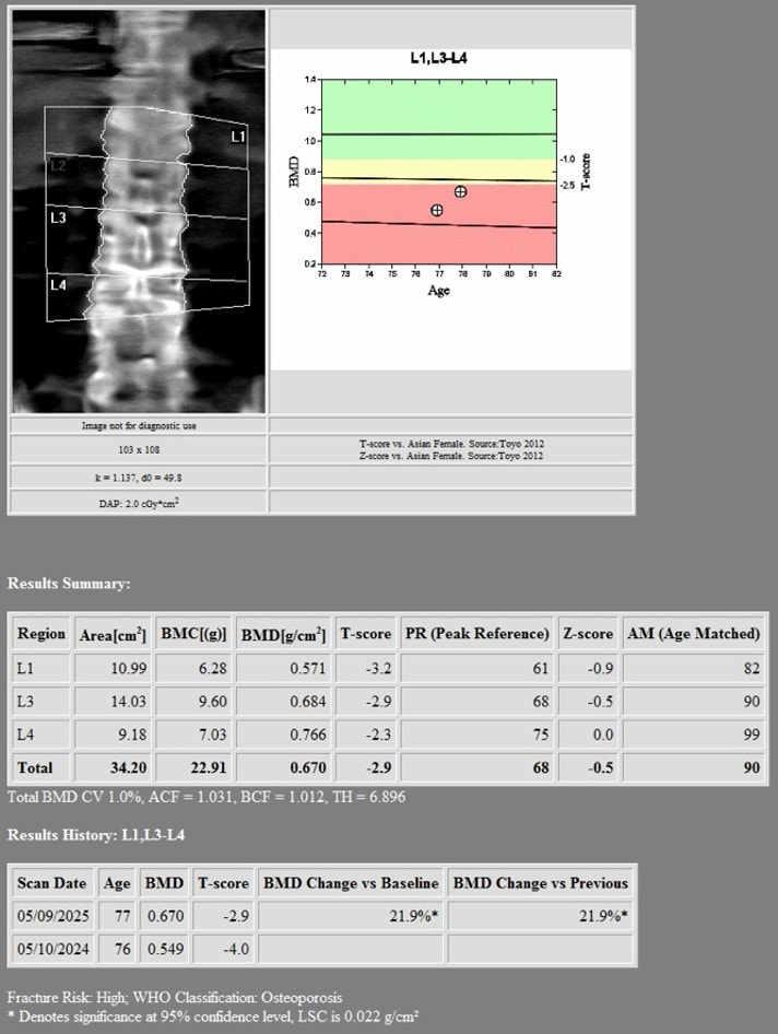 2nd DXA Scan (1 year after romosozumab treatment)