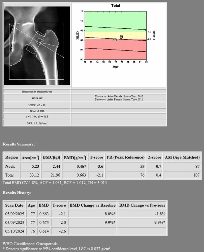2nd DXA Scan (1 year after romosozumab treatment)