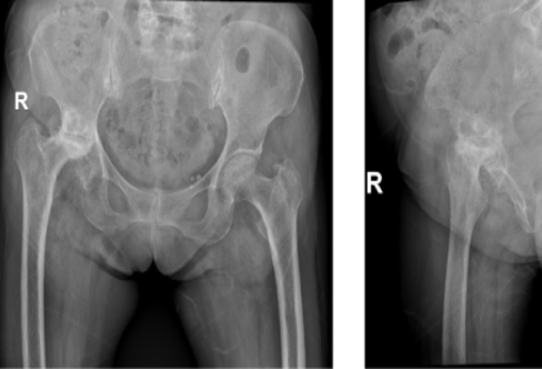 Hip X-ray