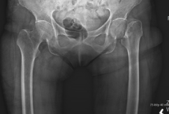 Hip X-ray