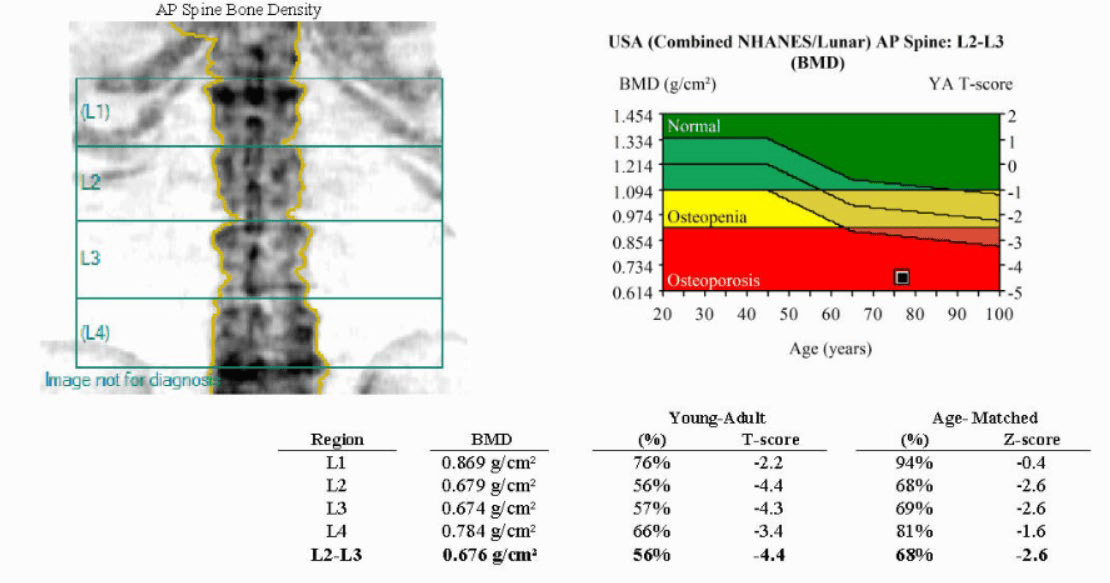 Baseline DXA Scan Results1
