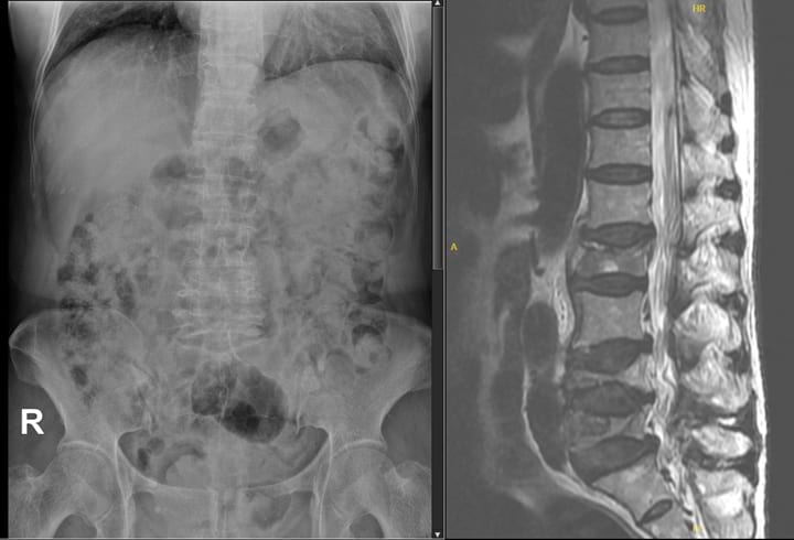 Lumbar X-ray